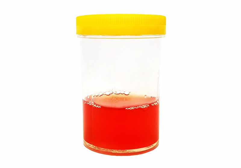 bloody urine sample in container