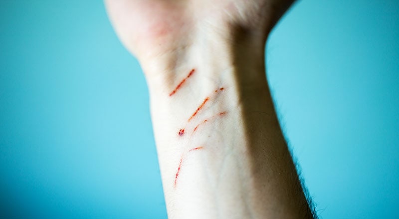 Hand after cat scratch