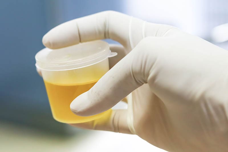 a cup of collected urine sample